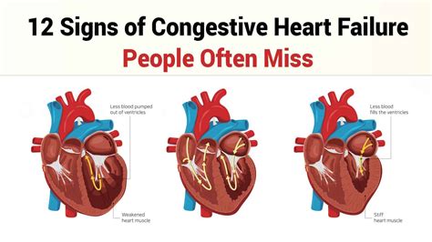 12 Congestive Heart Failure Symptoms - Causes, Diagnosis, Treatments ...