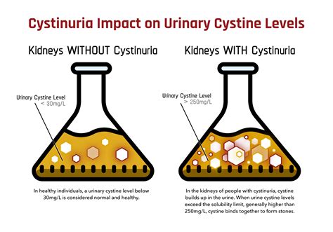 Cystine Kidney Stones