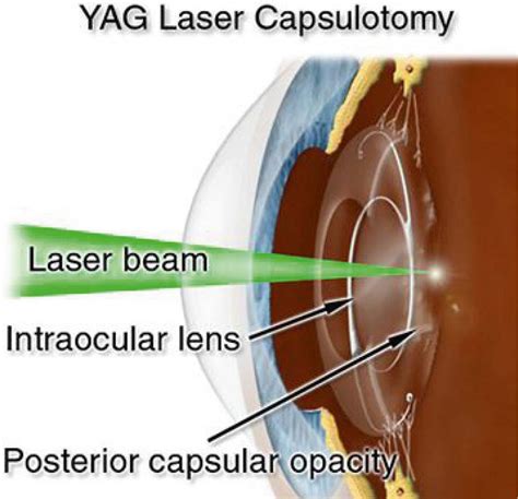 Yag Laser Capsulotomy - The Stoneygate Eye Hospital - Leicester