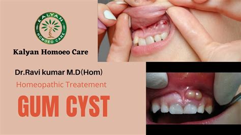 Gum Cyst Treatment In Homeopathy | Dr.Ravi Kumar M.D(Hom)Medicine ...