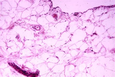 Synovial Biopsy, Synovium, Synovial Fluid and Arthrocentesis, H. Ralph ...