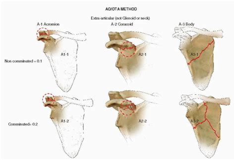 Scapula Fractures: Open Reduction Internal Fixation | Musculoskeletal Key