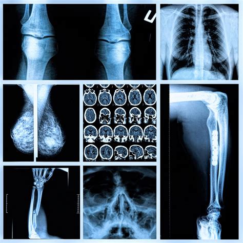 Cáncer de huesos: ¿Cuáles son los signos y síntomas de la enfermedad?