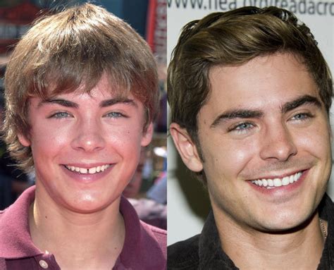 Zac Efron - Celebrity teeth - before & after - Digital Spy