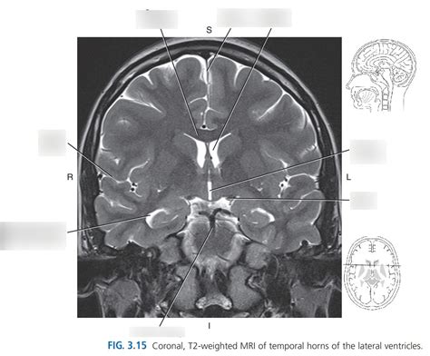 CORONAL MRI TEMPORAL HORNS LATERAL VENTRICLES Diagram | Quizlet