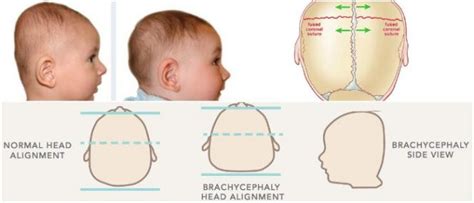 Brachycephaly: Causes, Symptoms, and Treatment - Hoool Health & Wellness