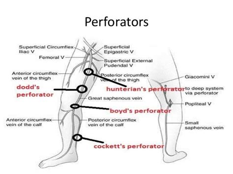 Varicose veins