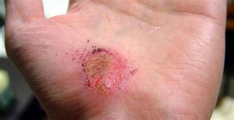 Abrasion on the hand; partially healed in places | Skin healing, Skin ...