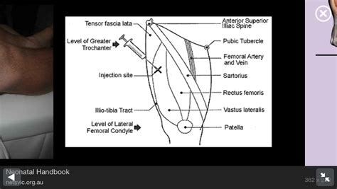 self im glute injection/needle size/scared to poke/soreness