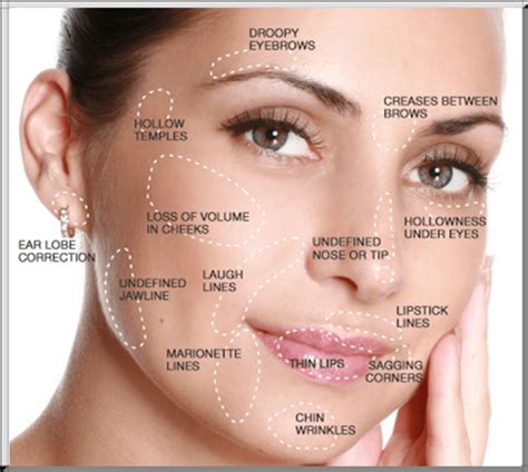 Where can you have Dermal Filler? | D'Souza Aesthetics