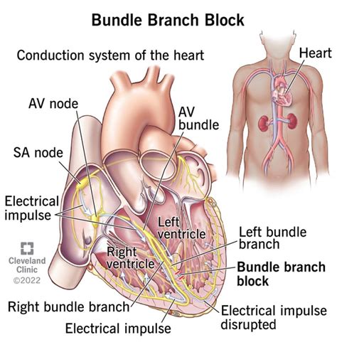 Right Bundle Branch Block Wikipedia, 40% OFF | frsc.gov.ng