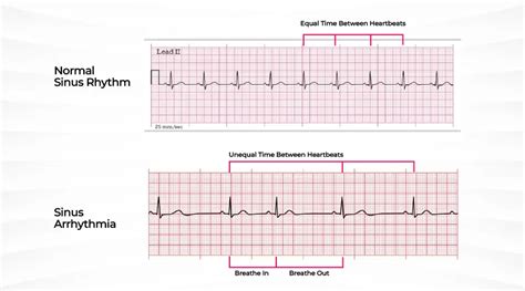 What Is Sinus Rhythm With Sinus Arrhythmia Store | www.jkuat.ac.ke