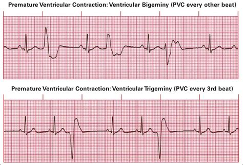 Ekg Patterns Premature Atrial Ventricular Contractions | The Best Porn ...