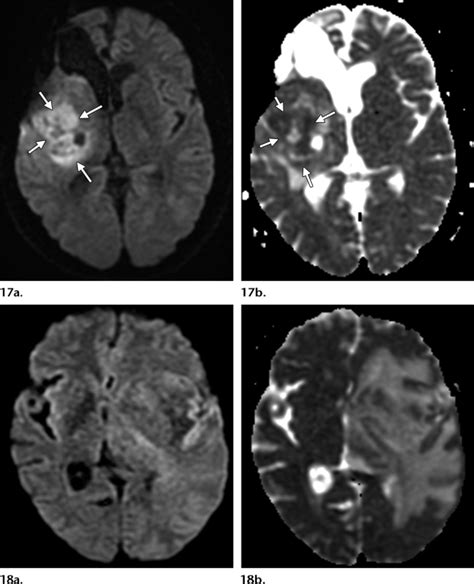 , 18. (17) Recurrent tumor. Axial diffusion-weighted image (a) and ...