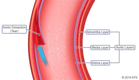 Aortic Dissection