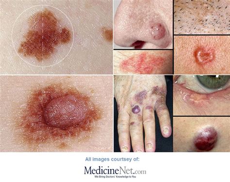 Precancerous Skin Lesions and Skin Cancer Pictures | Patients Crossing ...