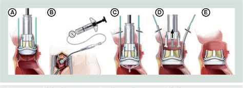 Current trends in aortic valve replacement: development of the rapid ...