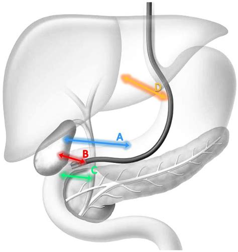 Cancers | Free Full-Text | Endoscopic Ultrasound Guided Biliary ...