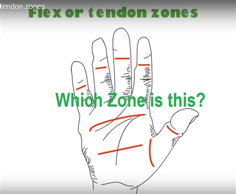 Flexor Tendon Zones of the Hand — OrthopaedicPrinciples.com