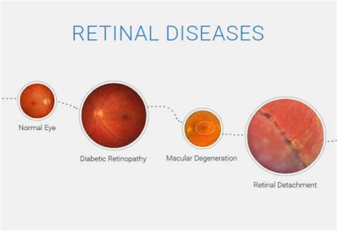 Retinal Care Fort Myers FL | Eye Centers of Florida