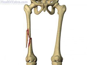 Femoral Fracture Definition, Causes, Symptoms, Complications and Cost ...