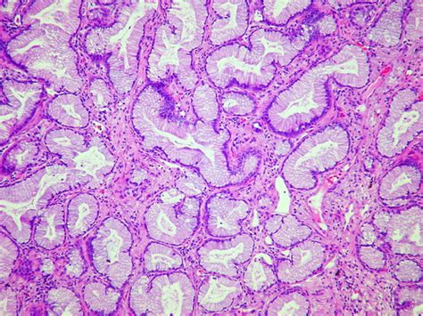 Adenocarcinoma, Mucinous; Carcinoma, Mucinous; Carcinoma, Colloid