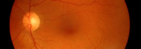 Color Fundus Photography | Department of Ophthalmology and Visual Sciences