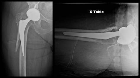 Periprosthetic Femur Fracture ORIF, Stem Revision