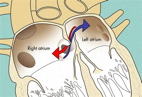 Patent Foramen Ovale - Causes, Symptoms, Diagnosis & Treatment