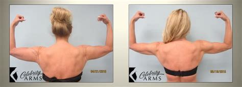 Arm Liposuction Before and After Results Small