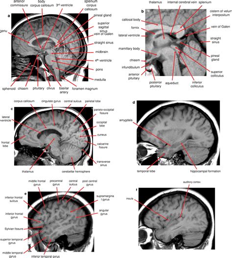 Normal anatomy of the brain on CT and MRI with a few normal variants ...