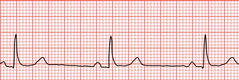 1-07. CARDIAC RHYTHMS | Cardiac Rhythm Interpretation