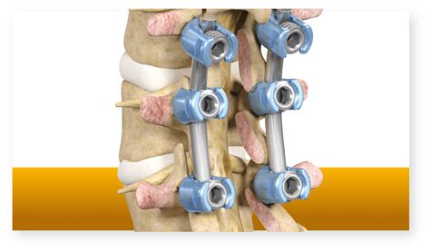 Lumbar laminectomy and fusion | Stryker | Stryker