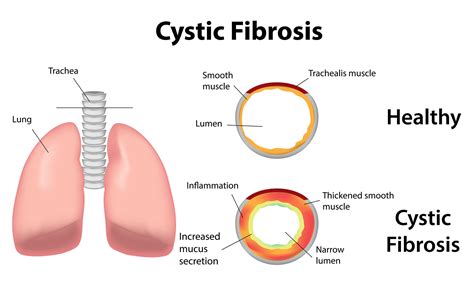 What are the signs and symptoms of Cystic Fibrosis? - Cystic Fibrosis DNA