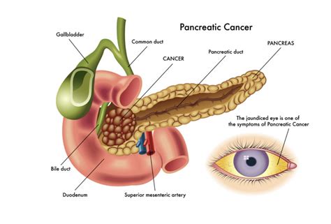 Dr Scott Gerber - A Novel Combination Therapy for Pancreatic Ductal ...