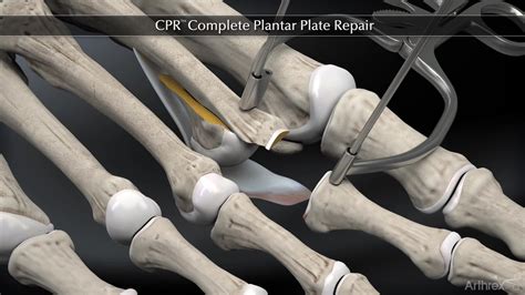 Arthrex - Complete Plantar Plate Repair System (CPR™)