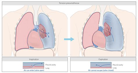 Open Pneumothorax