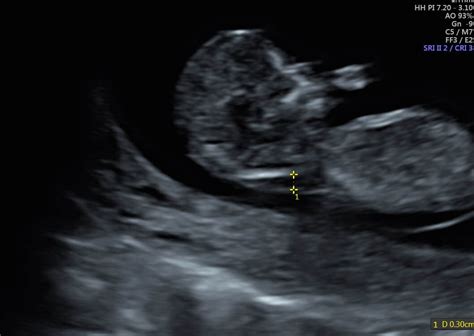 Nuchal Scan - Private Ultrasound London