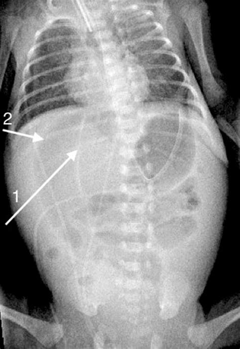 The 'football sign' is demonstrated with gas on either side of the ...