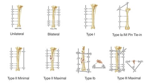 External Skeletal Fixation Nomenclature – Movora Webservices