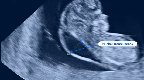 Nuchal Translucency Ultrasound (NT Scan): Test Results and More