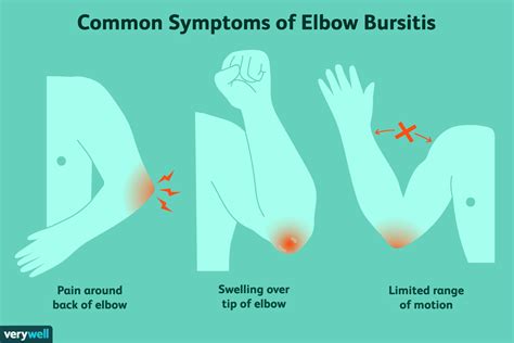 Elbow (Olecranon) Bursitis: Signs and Treatments