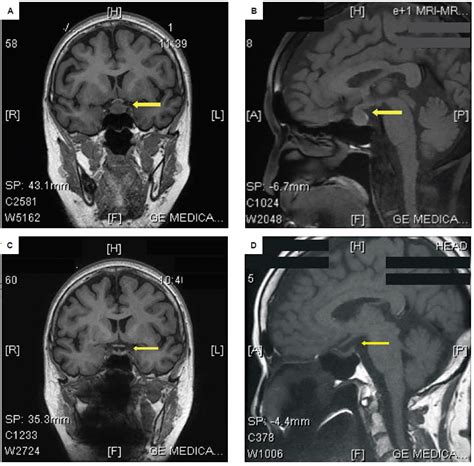 Pituitary Tumor Mri