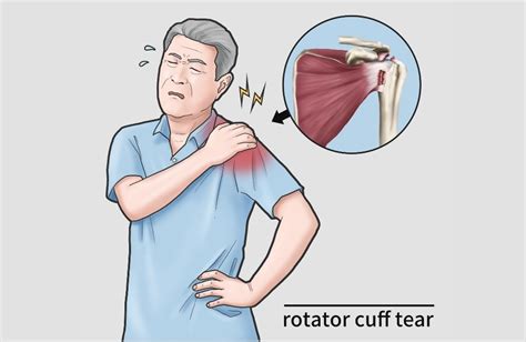 Rotator Cuff Injuries Can Be Devastating, Here Are 5 Best Exercises To ...