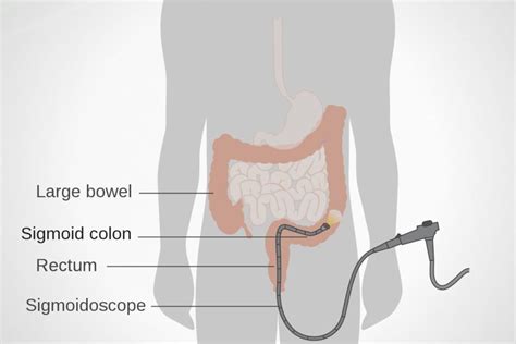 Sigmoidoscopy – NuLife Hospital – Gastroenterology, Liver Diseases ...