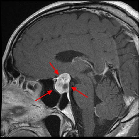 Pituitary Tumor - Signs, Symptoms, Diagnosis, MRI, Surgery & Treatment