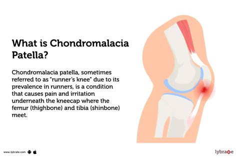 Chondromalacia Patella: Causes, Symptoms, Treatment and Cost