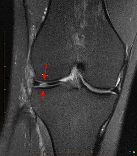 Torn Medial Meniscus Tear