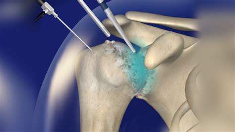 Shoulder Debridement | Diagnosis and Treatment for Shoulder Pain ...