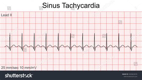 Sinus Tachycardia Rhythm Strip